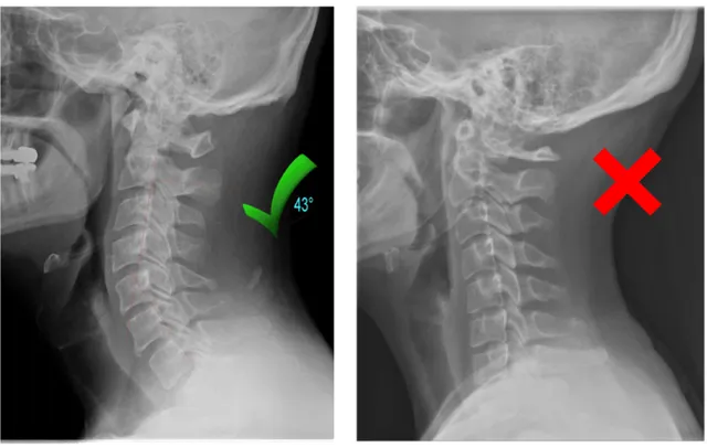 Your Neck Has Lost Its Natural Curve